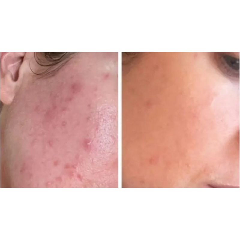 LED red light therapy mask for acne