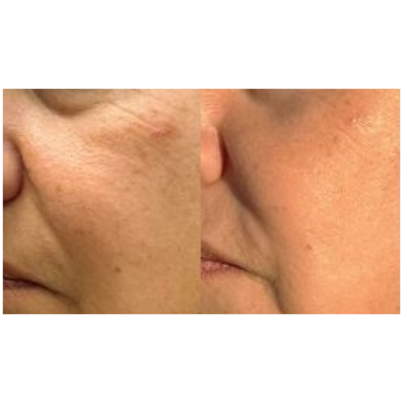 Omega Bright LED light therapy for anti-aging
