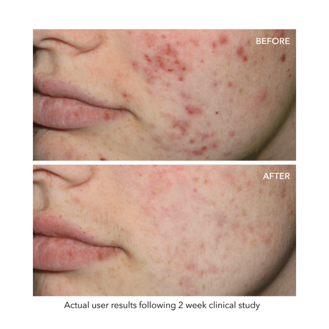 Quasar MD blue light therapy for acne