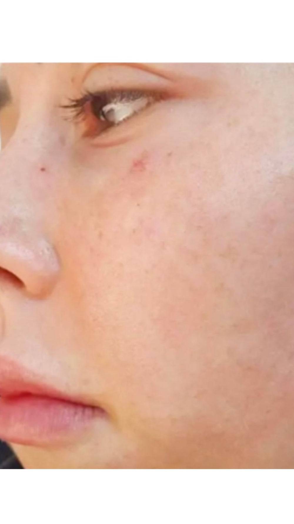 After consistent treatment