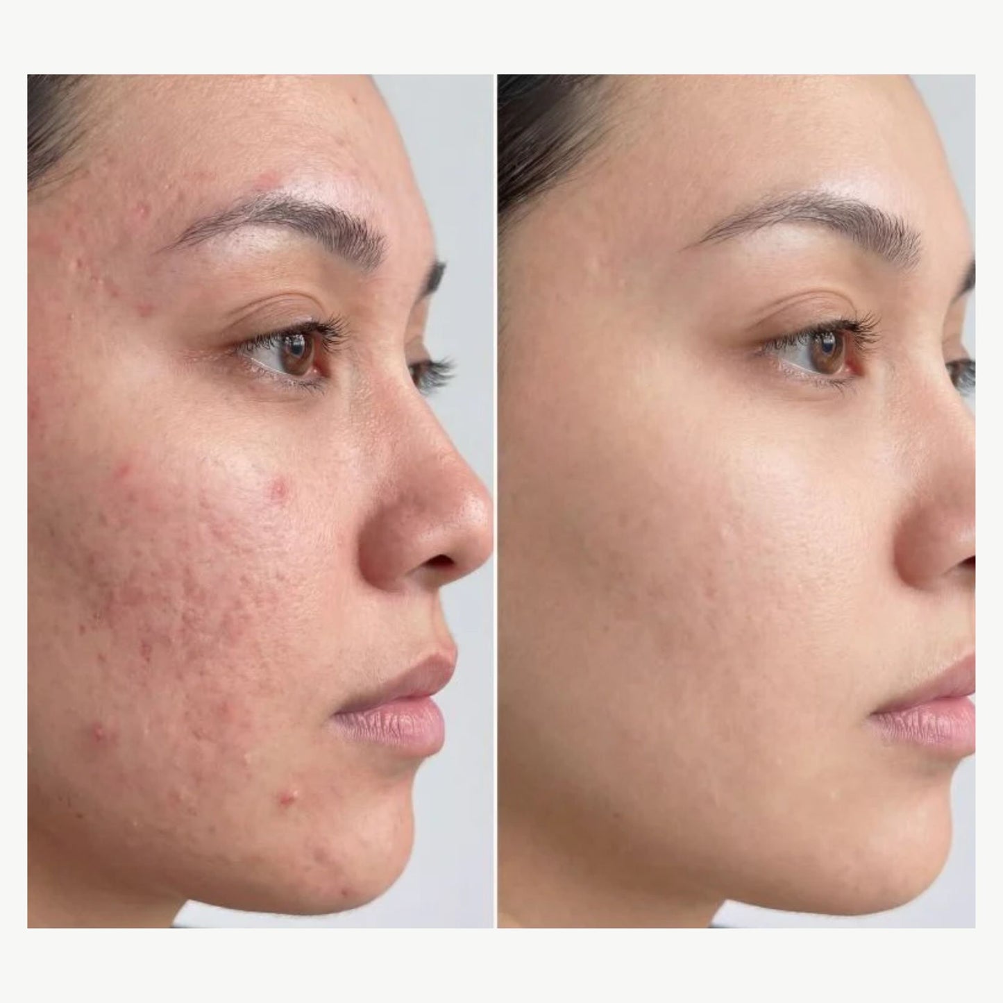 Before and after acne treatment results showing reduced breakouts, smoother skin texture, and improved skin clarity after consistent use of LED red light therapy device