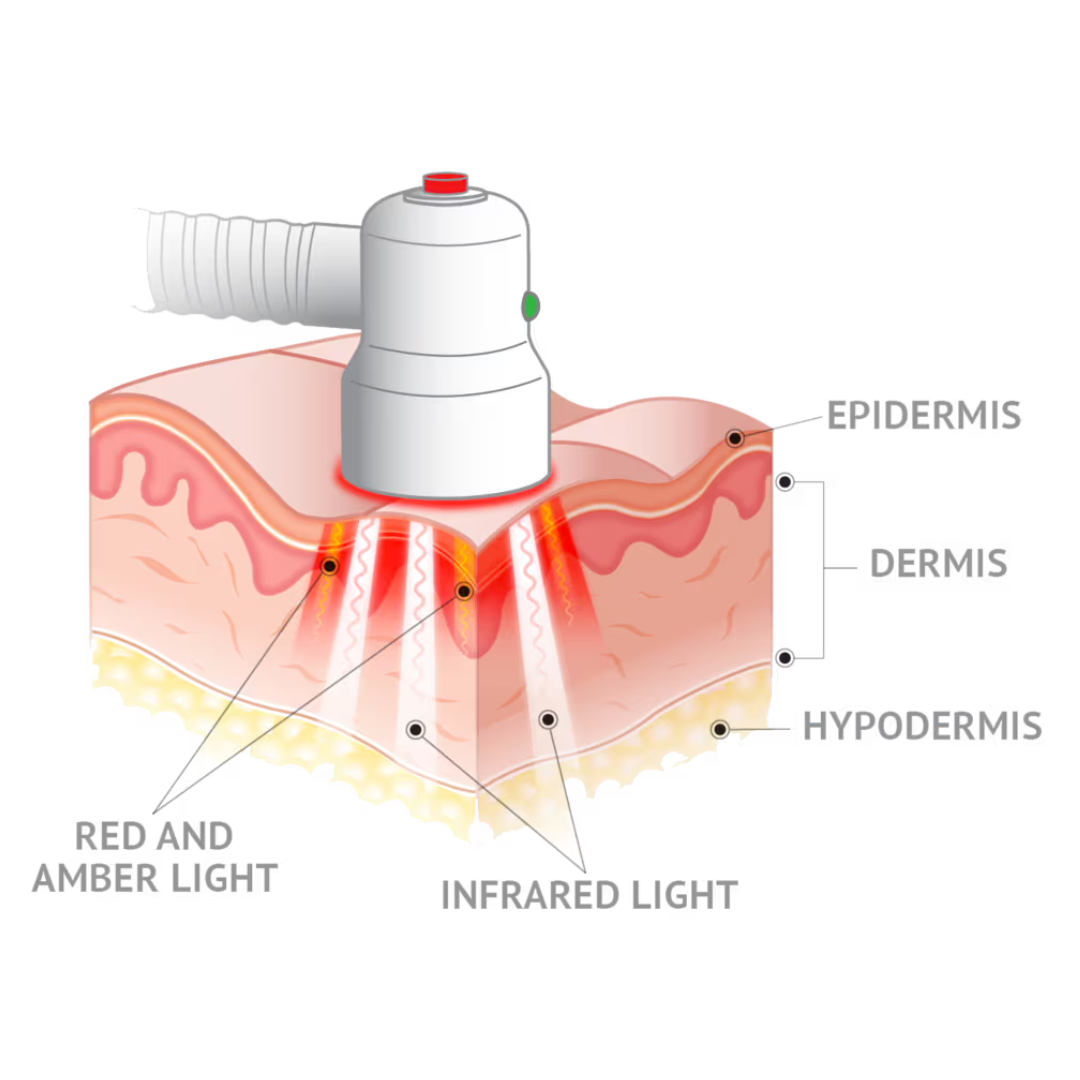 Quasar MD red light therapy