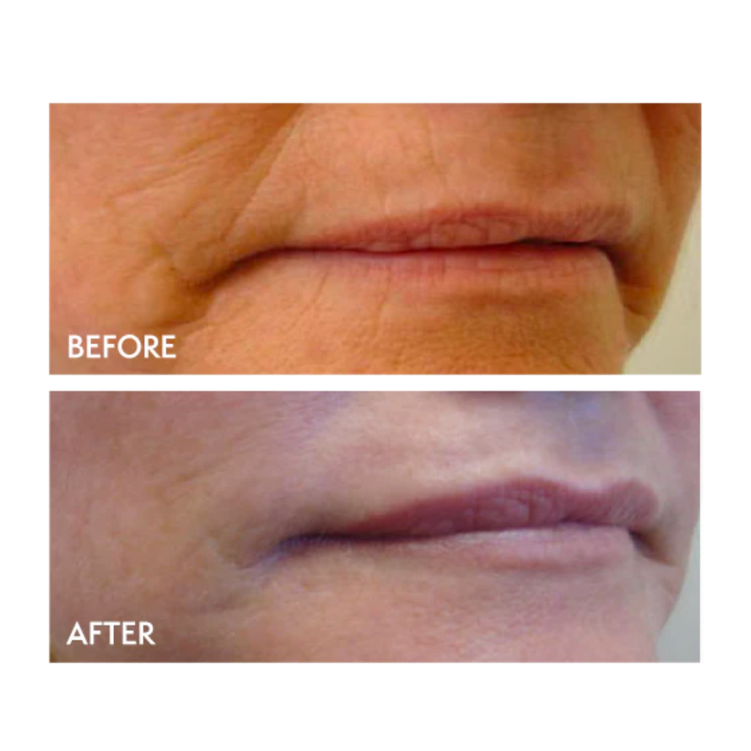 quasar md plus before and after results