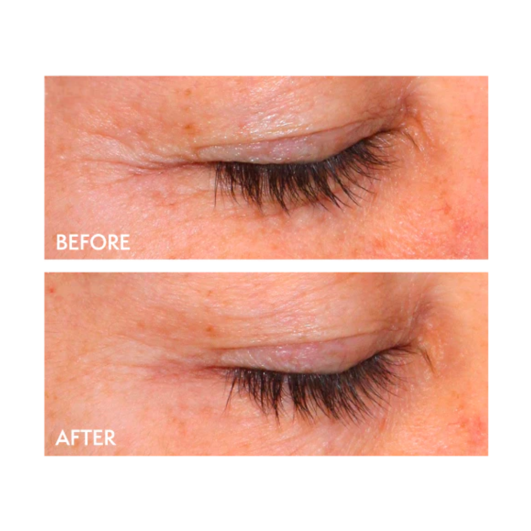 quasar md plus before and after